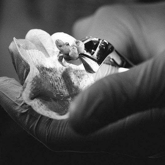 Exodontia Comprehensive Oral Surgery – Jason Hoium Module 1-13