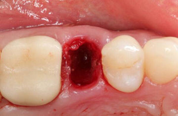 Extraction Socket – Preservation/Grafting; Immediate vs Delayed Implants; Pontic Site Development