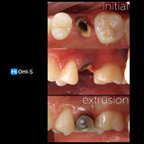 Saving Hopeless Teeth: Surgical and Conservative Protocols