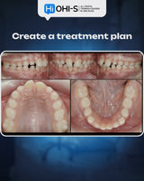 Missing Maxillary Lateral Incisors: Space Closure in All Malocclusions vs. Implants and Prosthetic Replacement