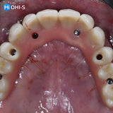 Removable dentures for dentists and technicians