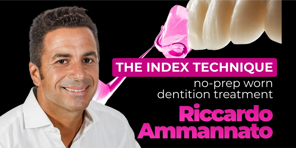 The Index Technique: no‑prep worn dentition treatment