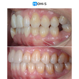 Orthodontic Preparation Before Prosthetics