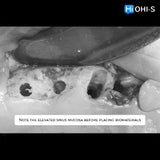 Predictable Sinus Lift