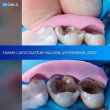 The Biomimetic Concept: Composite Restoration Protocols