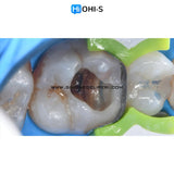 The Biomimetic Concept: Composite Restoration Protocols