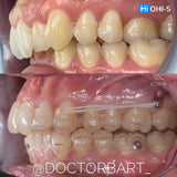 Aligners and Microimplants: Combined Protocol