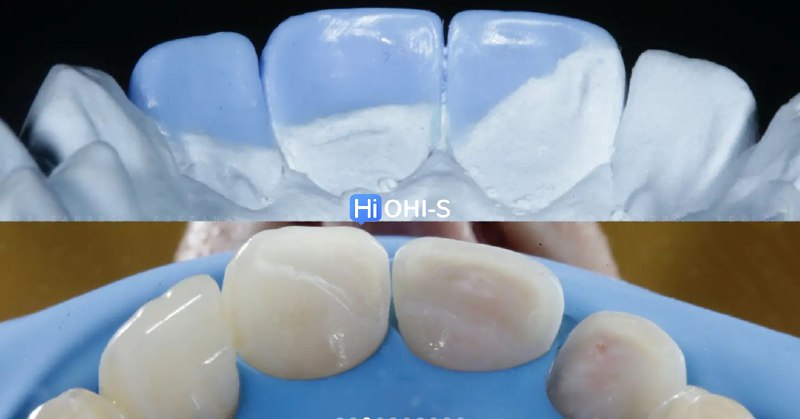 International Schools Working with Composite Restorations