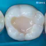 International Schools Working with Composite Restorations