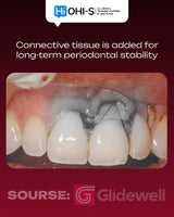 Advanced Periodontology: Surgical Protocols