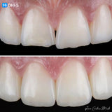 The Biomimetic Concept: Composite Restoration Protocols