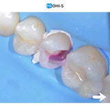 The Biomimetic Concept: Composite Restoration Protocols