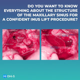 Predictable Sinus Lift