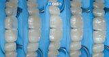 International Schools Working with Composite Restorations