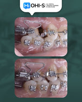 Biomechanics in Orthodontics