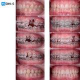 Orthodontic Preparation Before Prosthetics