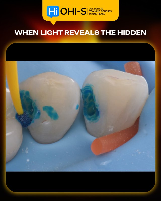 International Schools Working with Composite Restorations