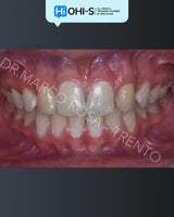 Early Orthodontic Treatment: When and How?