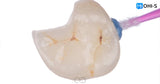 All‑Digital Workflow: Protocols for Flawless Indirect Restorations