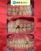 Aligners and Microimplants: Combined Protocol