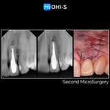 Apical Surgery: For Endodontists and Surgeons
