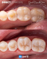 The Biomimetic Concept: Composite Restoration Protocols