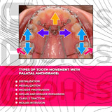 Challenging orthodontic cases: the use of skeletal anchorage