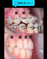 Damon 2.0. How to treat all common malocclusions