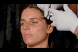 Botox and filler online course - RA Summit 2024