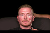 Botox and filler online course - RA Summit 2024