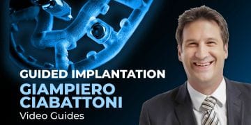 Guided implantation. Giampiero Ciabattoni Video guides