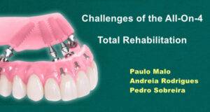 Сhallenges of the All-On-4 Total Rehabilitation - Dental Courses | كورسات طب اسنان