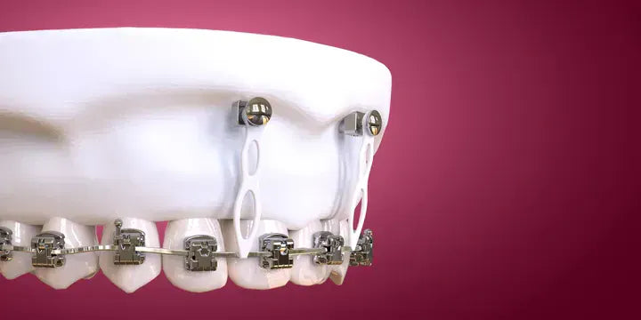 Microimplant Anchorage in Clinical Practice: Guide for Beginners and Intermediate