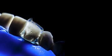 Occlusion-driven stress-reduced direct composite (SRDC)