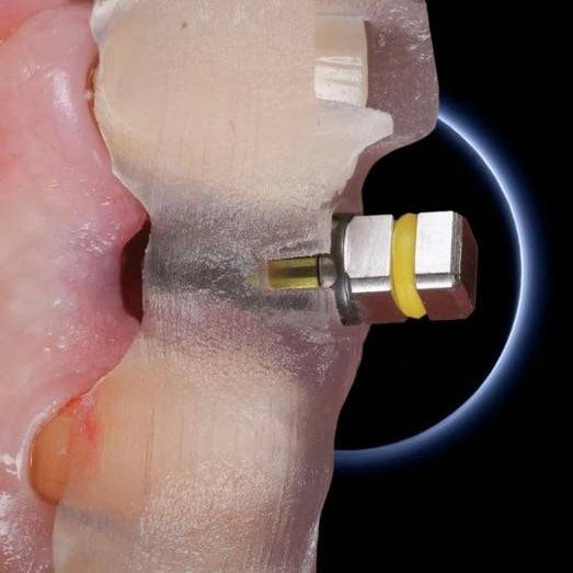 OHI-S Implant Placement in the Aesthetic Zone: Steps and Technique