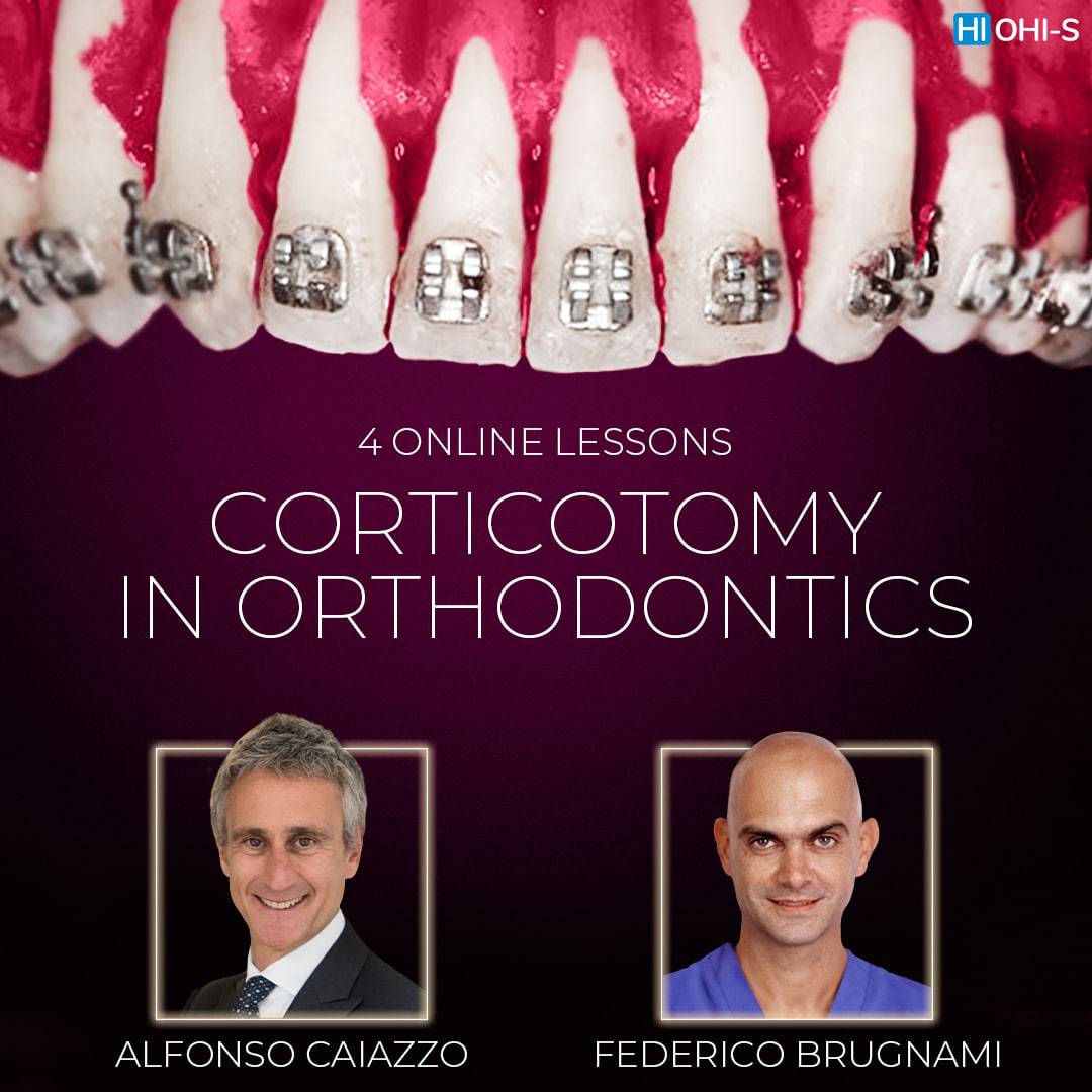 ohi-s Orthodontic corticotomy. The clinical use of corticotomy and guided bone regeneration