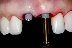 Gidental Online Residency Program: A-Z in Implant Dentistry - Dental Courses | كورسات طب اسنان