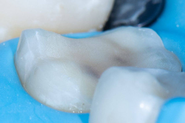 Overlay, Onlay and Advanced Adhesion