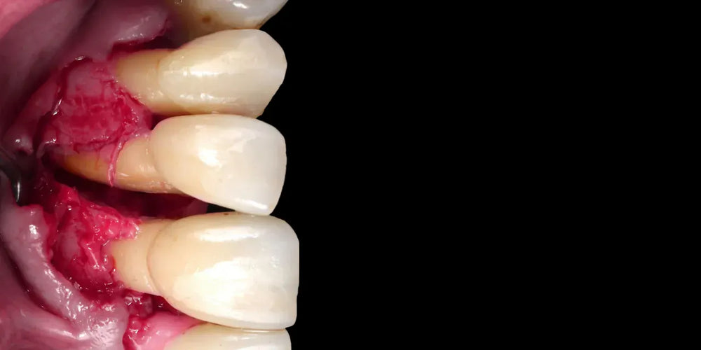 Periodontitis – Surgical and Non-Surgical Treatment Methods