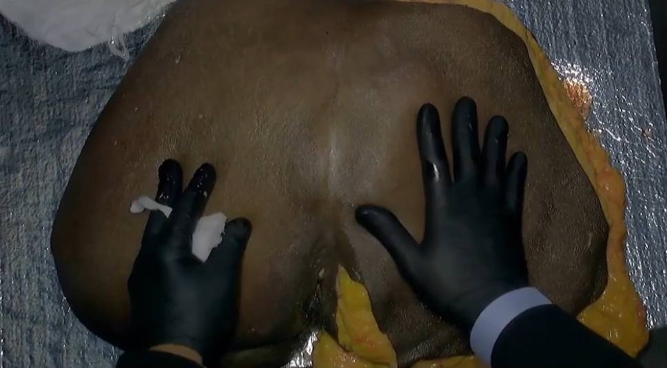 Gluteal Demonstration ,  PMMA , Calcium Hydroxyapatite