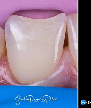 Composite Veneers, All Restorative Techniques