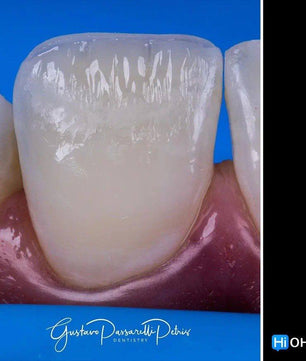Composite Veneers, All Restorative Techniques