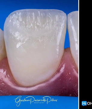 Composite Veneers, All Restorative Techniques