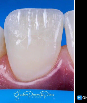 Composite Veneers, All Restorative Techniques