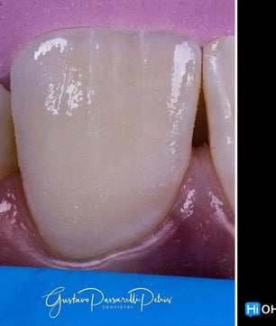 Composite Veneers, All Restorative Techniques