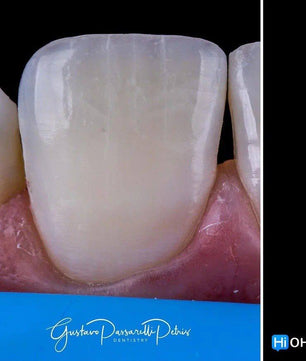 Composite Veneers, All Restorative Techniques