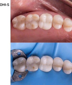 The Biomimetic Concept: Composite Restoration Protocols