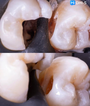 The Biomimetic Concept: Composite Restoration Protocols