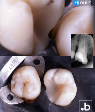 The Biomimetic Concept: Composite Restoration Protocols