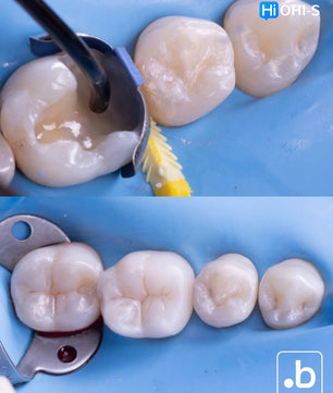 The Biomimetic Concept: Composite Restoration Protocols